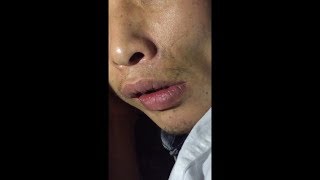 Orofacial Dyskinesia [upl. by Akemot667]