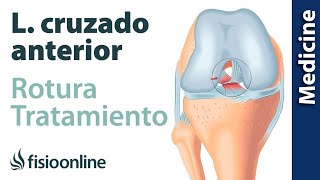 Rotura de ligamento cruzado anterior  Diagnóstico tratamiento de fisioterapia médico y quirúrgico [upl. by Angeli]