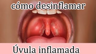 Uvula inflamada como desinflamarla y quitar puntos rojos y pus [upl. by Annawaj]