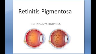 Ophthalmology 297 Retinitis Pigmentosa Dystrophy night blind dominant bone corpuscle ERG vitamin A [upl. by Innoj258]