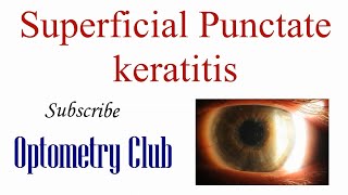 Superficial Punctate Keratitis Introduction Diagnosis and Treatment [upl. by Leseil930]